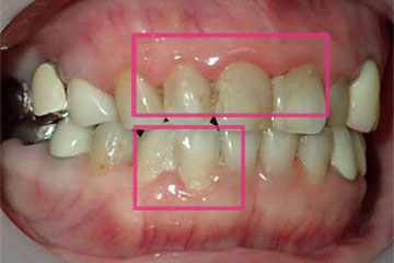 磨き残しによる歯周病が見られます