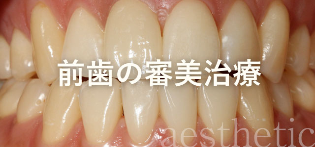 前歯の審美治療例