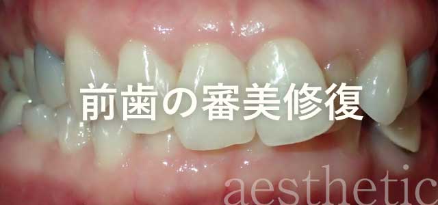 前歯の審美修復例