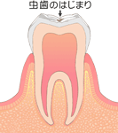 「C0」虫歯のスタート