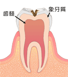 「C2」虫歯が大きく進行