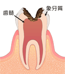 「C3」歯の神経まで虫歯が進行