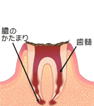 「C4」ほとんど歯が無い