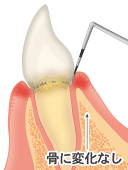 軽度の歯肉炎