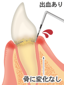 出血を伴う歯肉炎