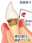 重度の歯周炎