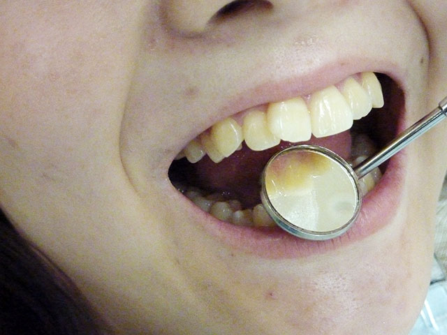 歯、歯肉、お口の中全体の状態をチェック