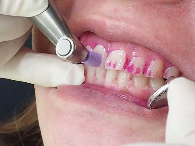 口腔内の清掃