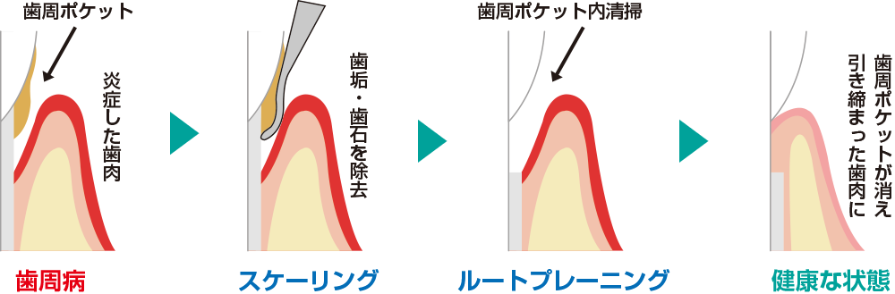 歯と歯根のスケーリング、ルートプレーニング