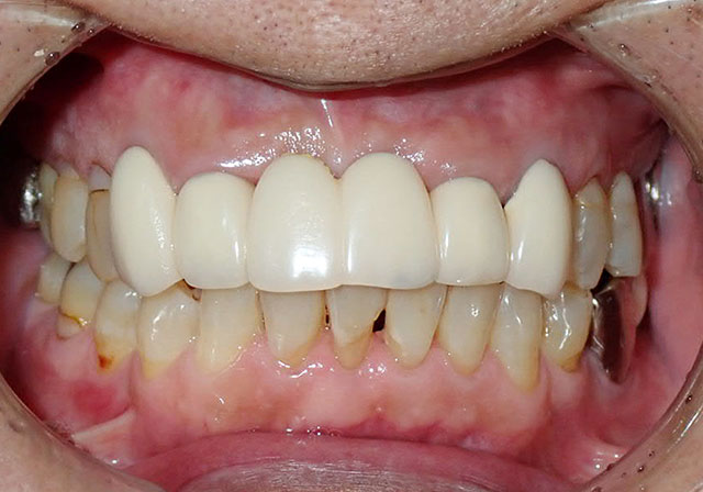 治療後から9年経過した歯の状態