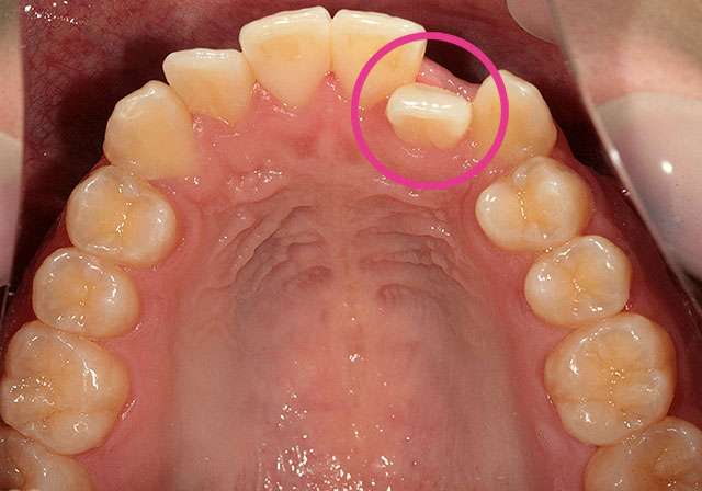前歯 へこみ