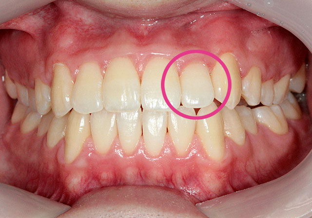 前歯 表面 へこみ