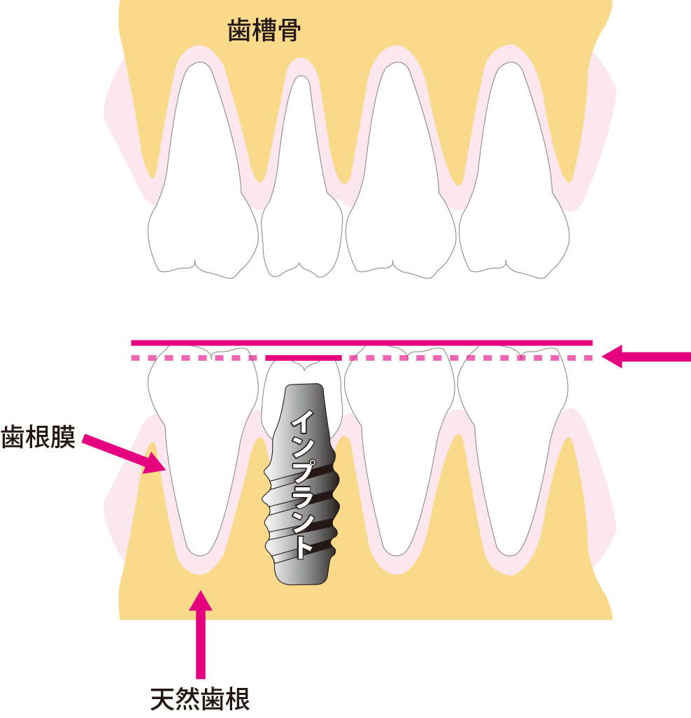 インプラントの噛み合わせ