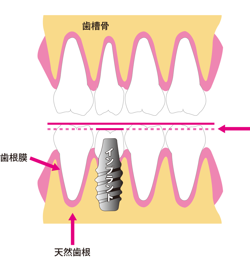 インプラントの噛み合わせ