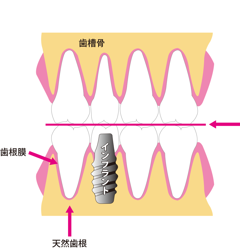 インプラントの噛み合わせ