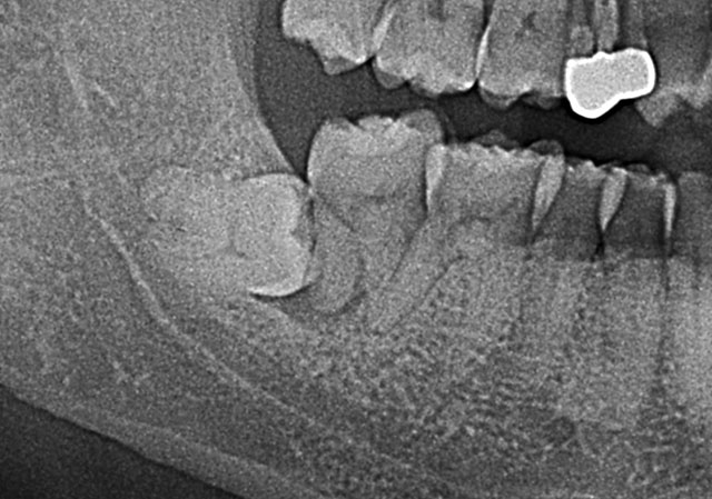 親知らずが原因で手前の健康な歯が重症ぼ歯周病になってしまった症例